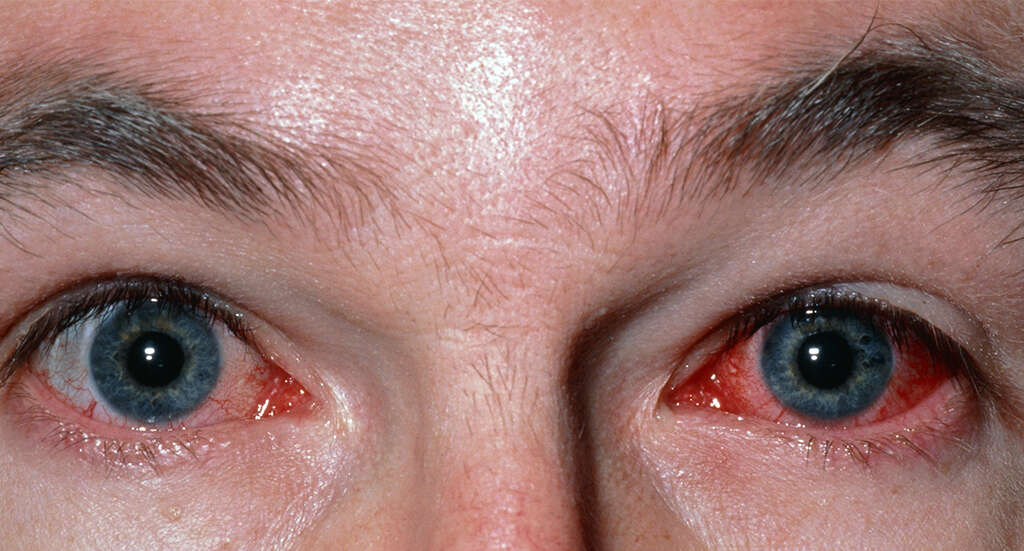 Ocular Disease Management & Diagnosis